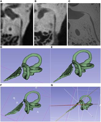 Vestibular Aqueduct Morphology and Meniere's Disease—Development of the “Vestibular Aqueduct Score” by 3D Analysis